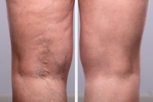 Vein Treatment Center in Crystal Lake, IL