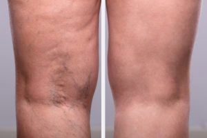 person's legs before and after varicose and spider vein treatment